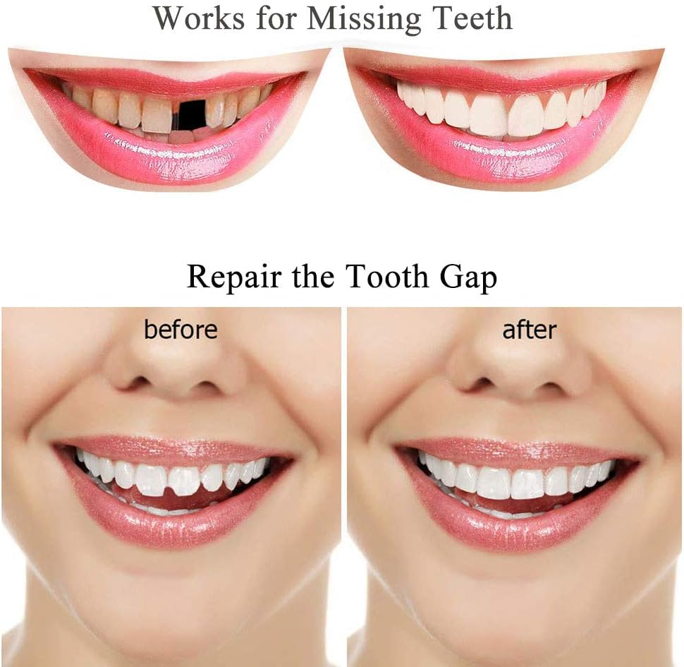 Tooth Repair Kit-Thermal Beads for Filling Fix The Missing and Broken Tooth or Adhesive The Denture Fake Teeth